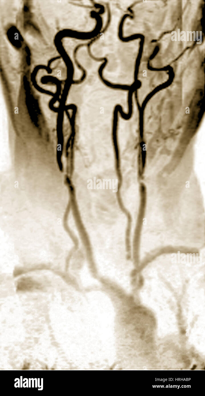 Internal carotid artery stenosis hires stock photography and images