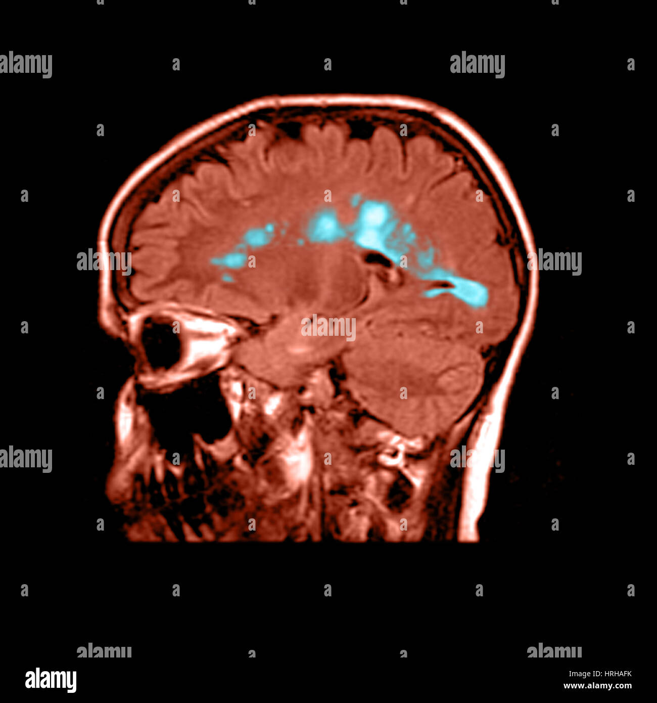 MRI of Multiple Sclerosis Stock Photo - Alamy