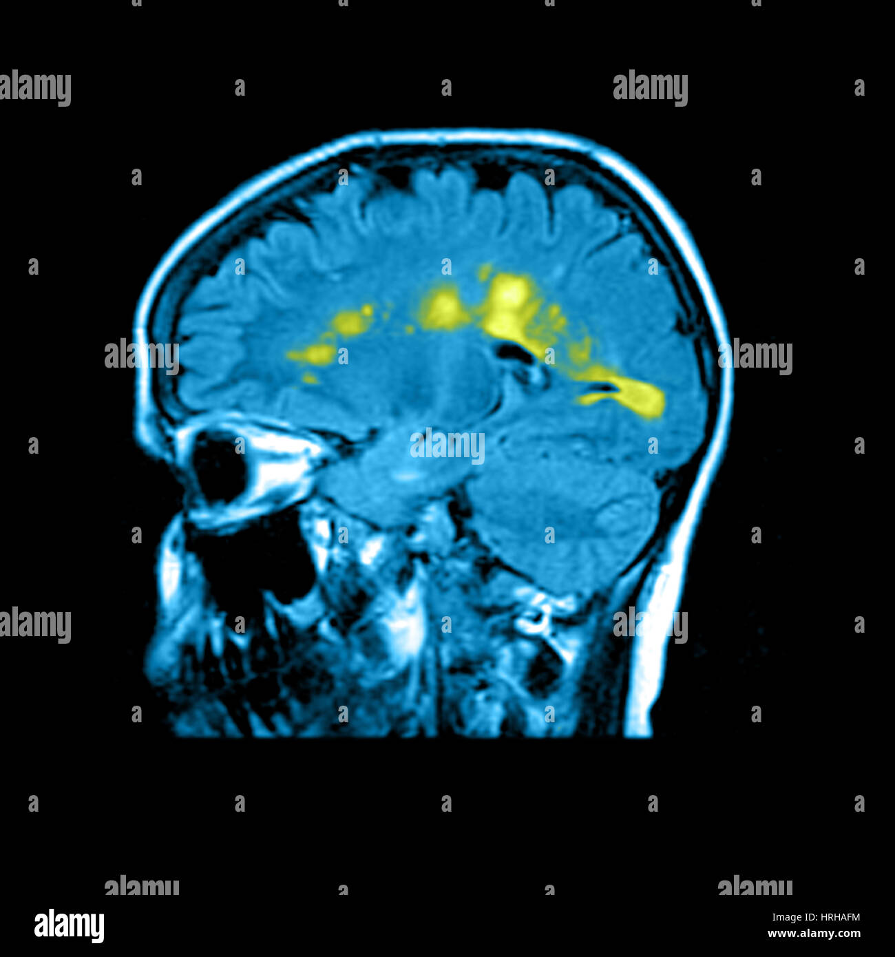 MRI of Multiple Sclerosis Stock Photo Alamy