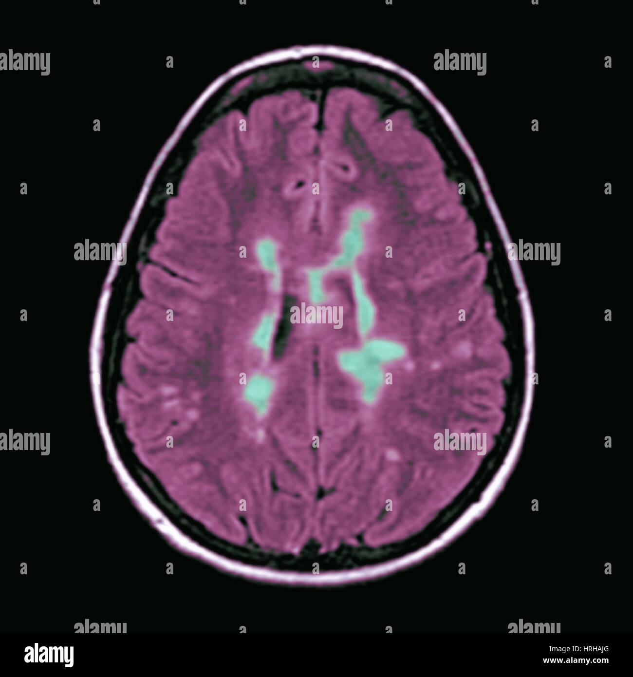 Multiple sclerosis mri hires stock photography and images Alamy