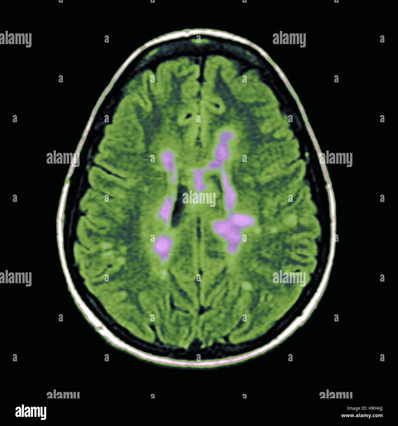 MRI of Multiple Sclerosis Stock Photo Alamy
