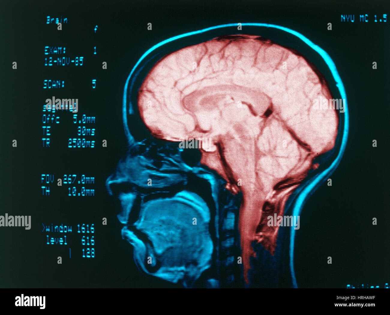 Arteriography hi-res stock photography and images - Alamy