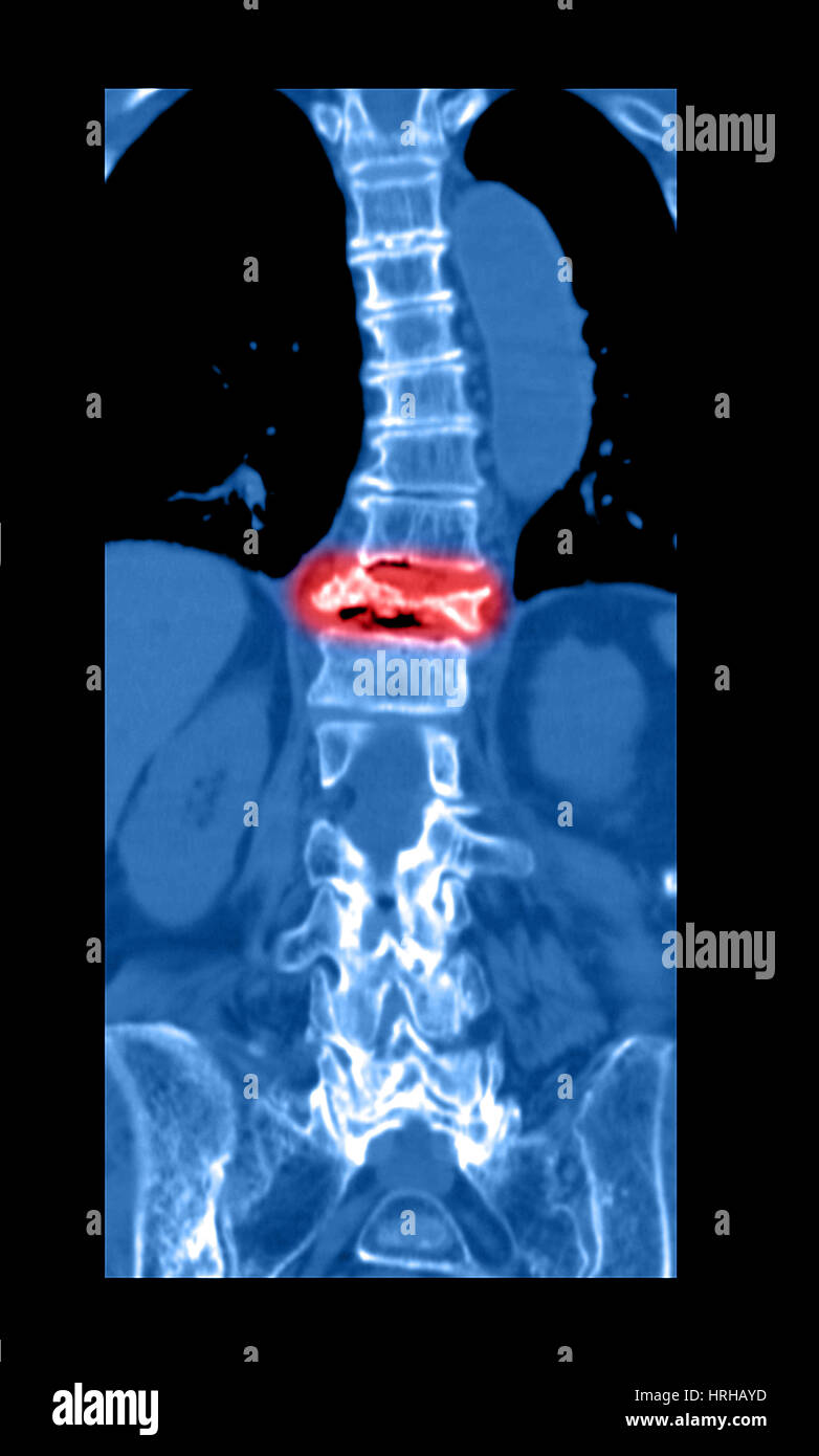 Severe Osteoporosis Stock Photo Alamy