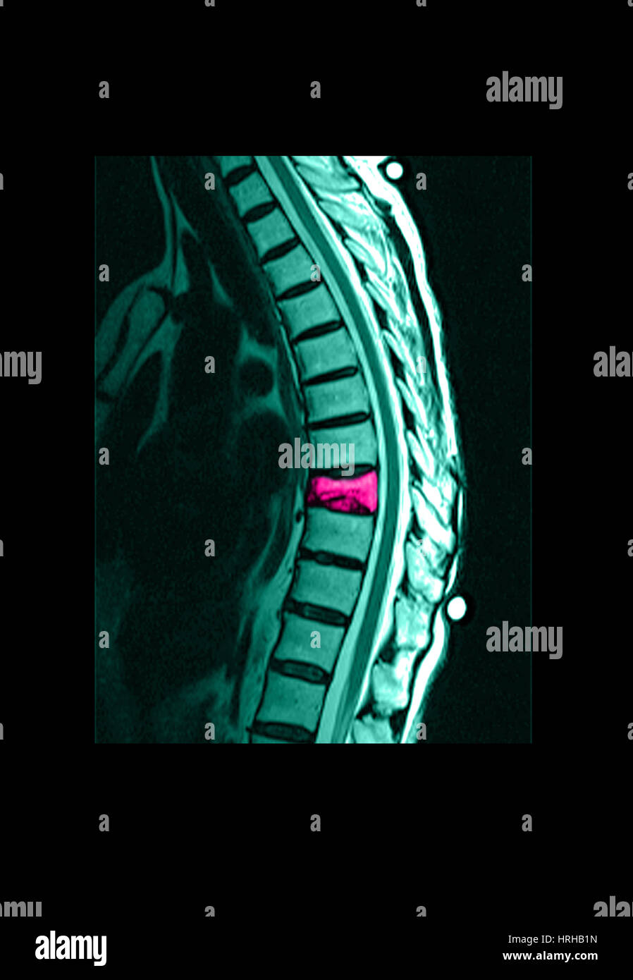 Spinal Compression Fracture Stock Photo