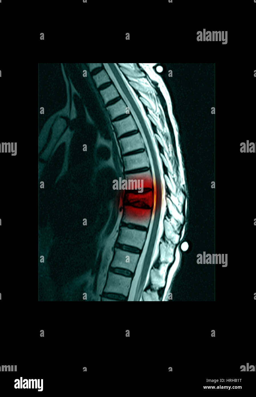 Spinal Compression Fracture Stock Photo