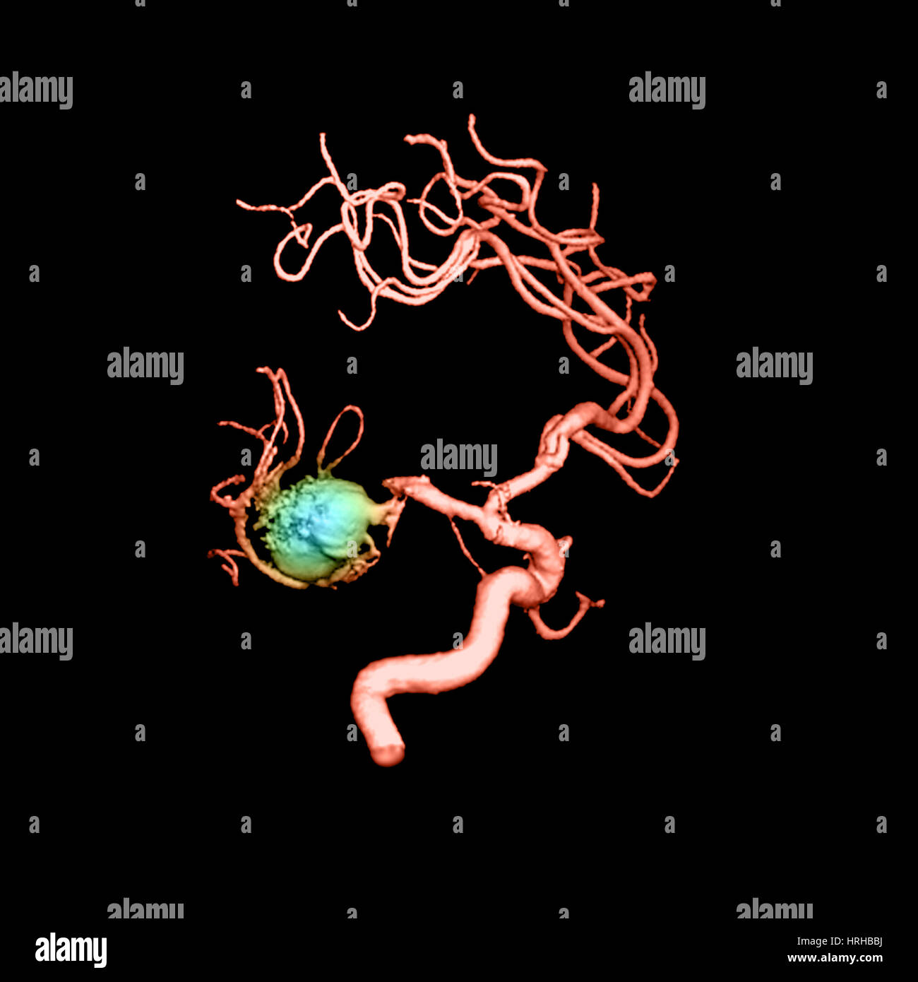 Aneurysm in the Human Brain Stock Photo - Alamy