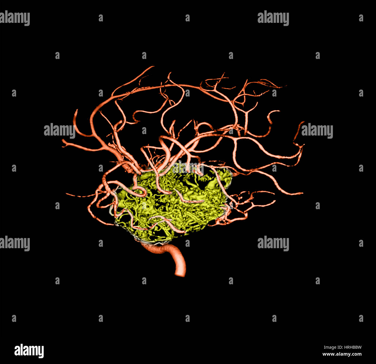 3D Angiogram of Temporal Lobe AVM Stock Photo