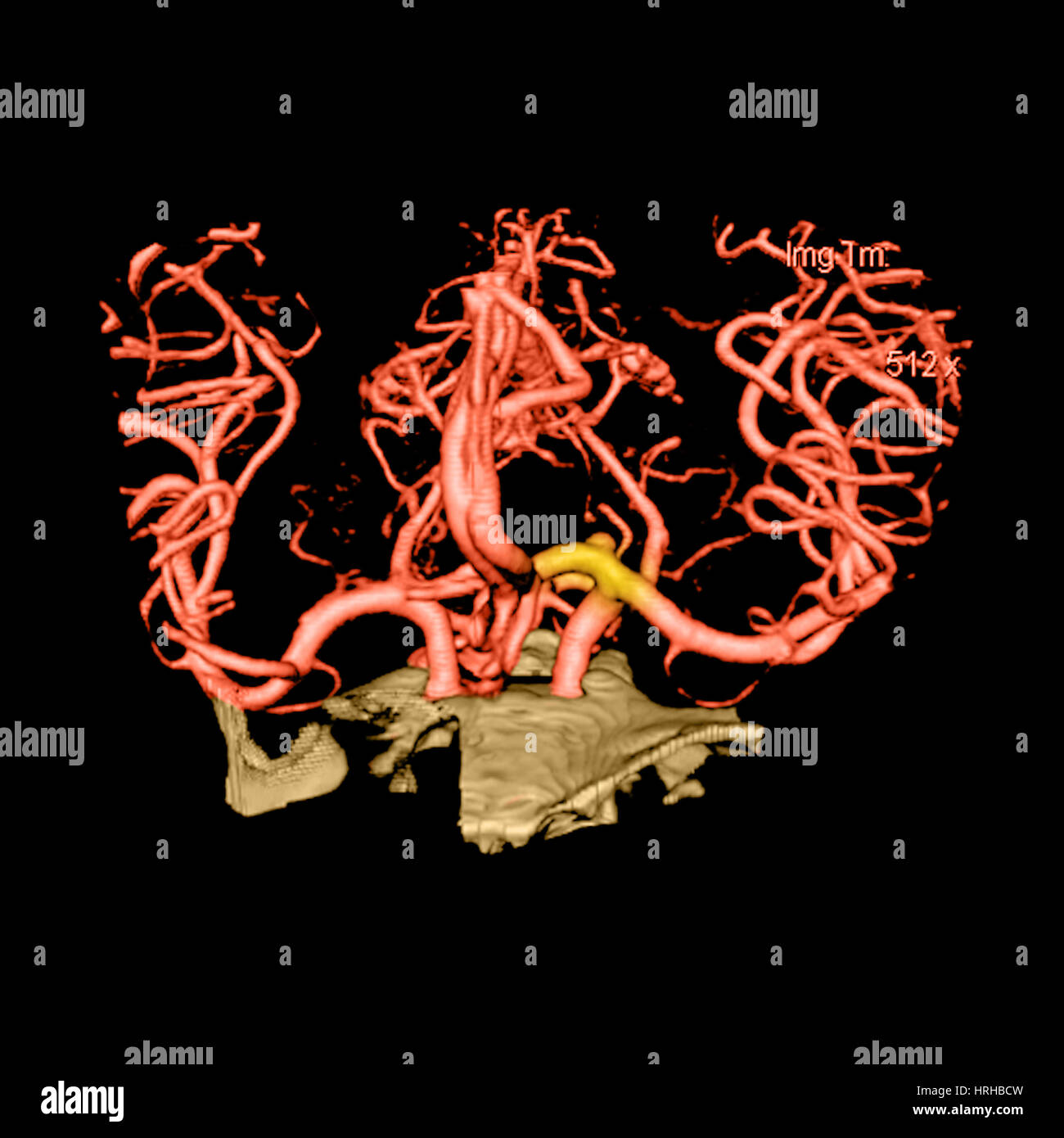 CT Angiogram of Aneurysm Stock Photo
