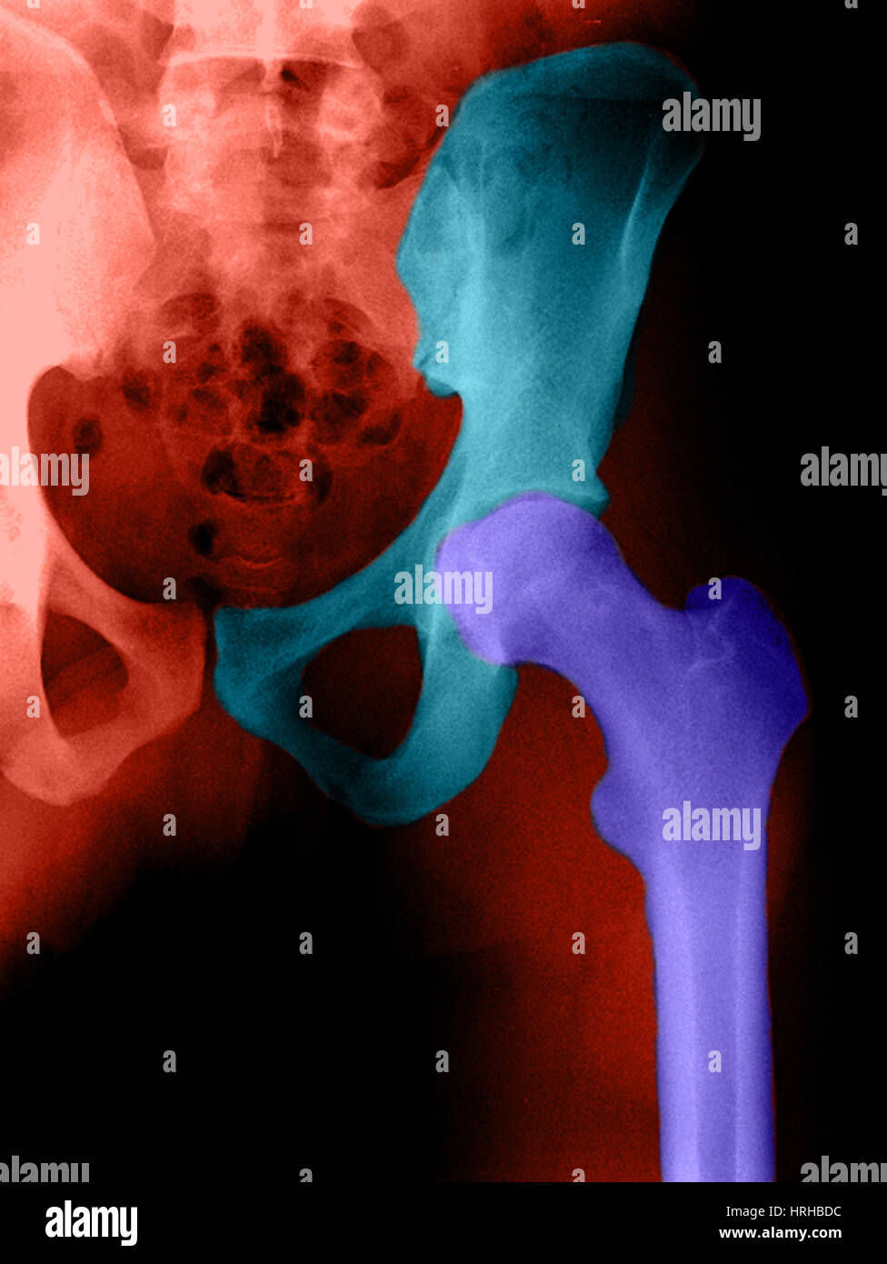 XRay of the Hip Stock Photo Alamy
