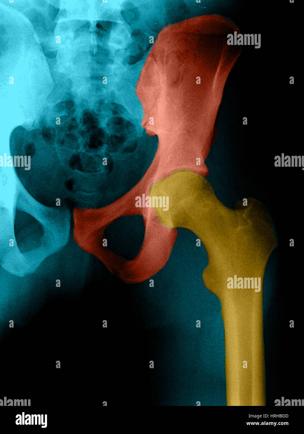 XRay of the Hip Stock Photo Alamy