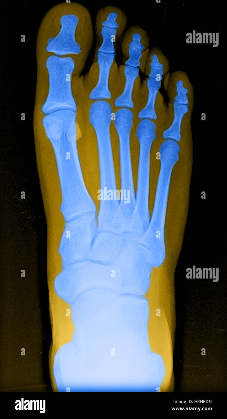 X ray normal foot hires stock photography and images Alamy