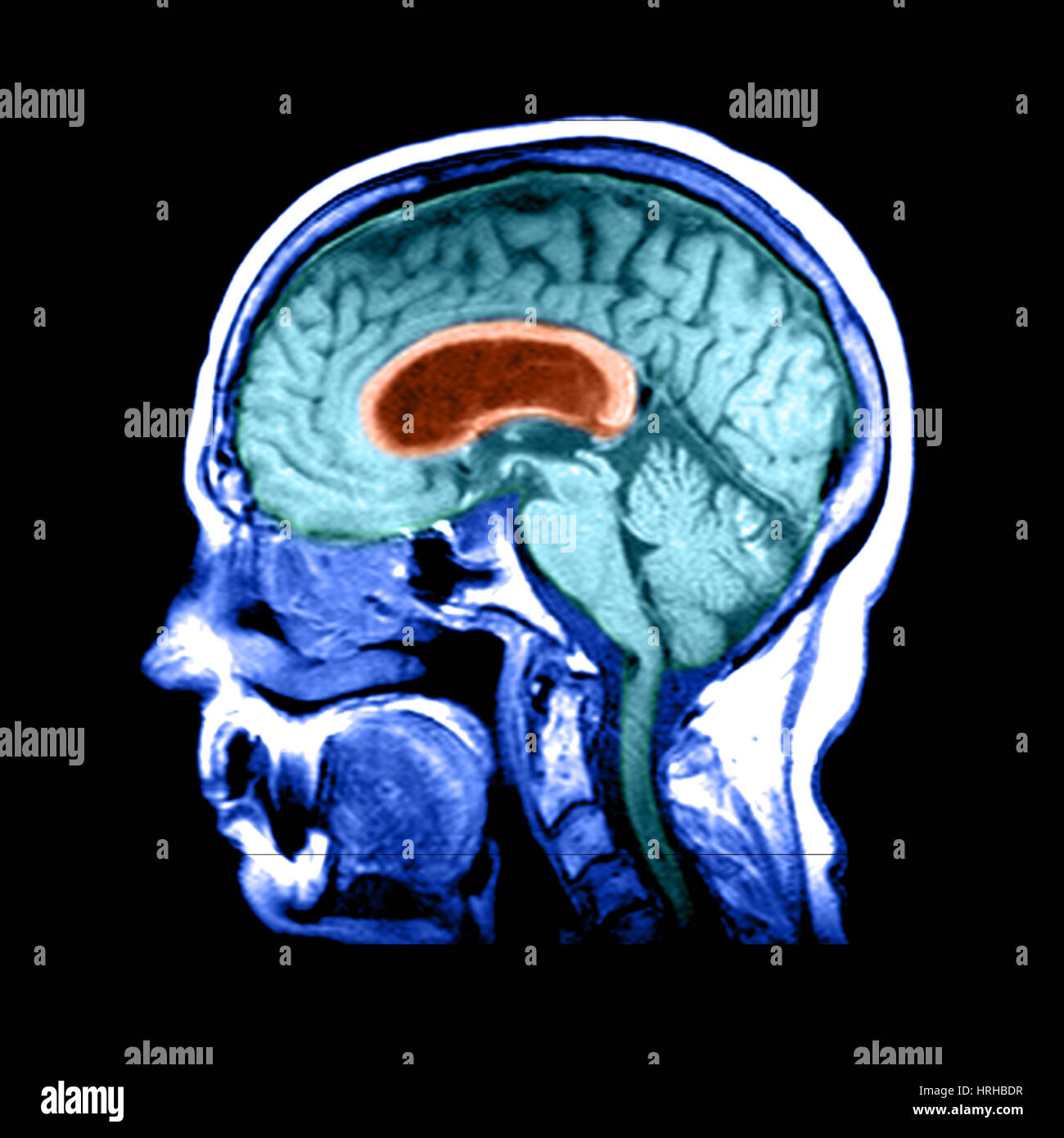 Hydrocephalus Stock Photo