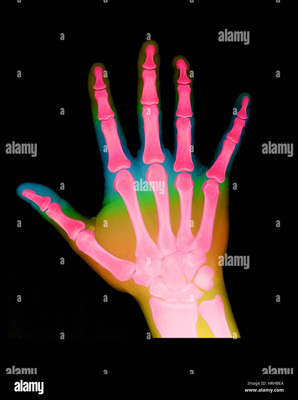 XRay of a Hand Stock Photo Alamy