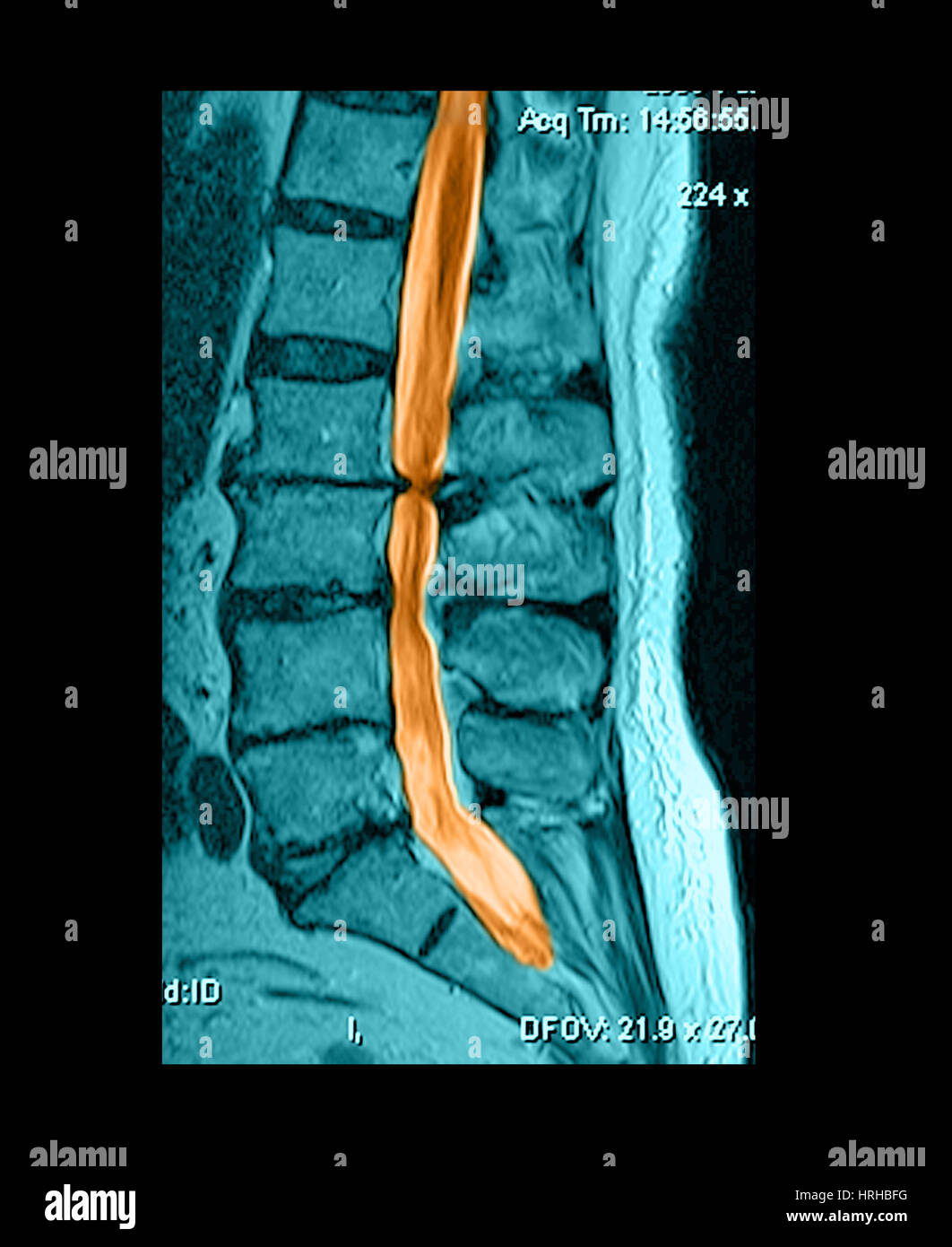 Spinal stenosis xray hires stock photography and images Alamy