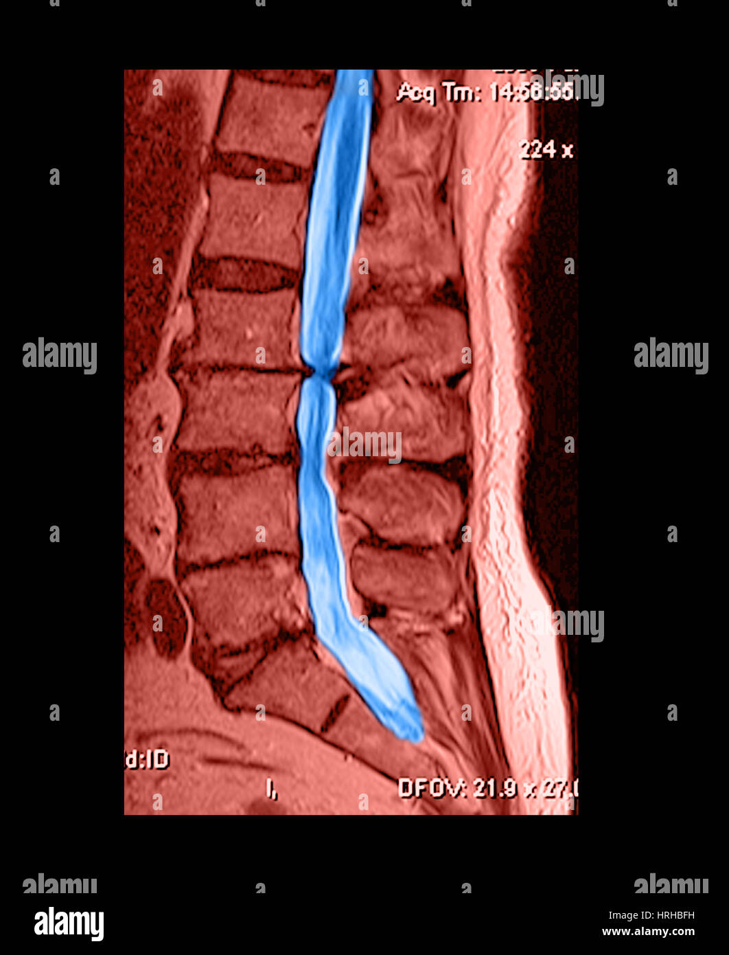 Djd lumbar spine hi-res stock photography and images - Alamy