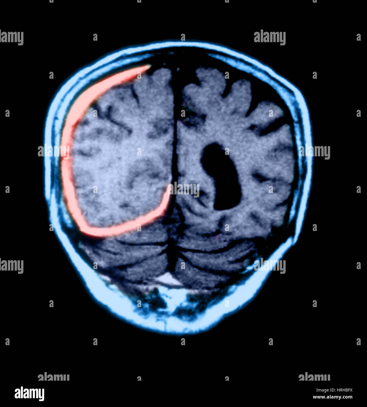 MRI of Head Trauma Stock Photo