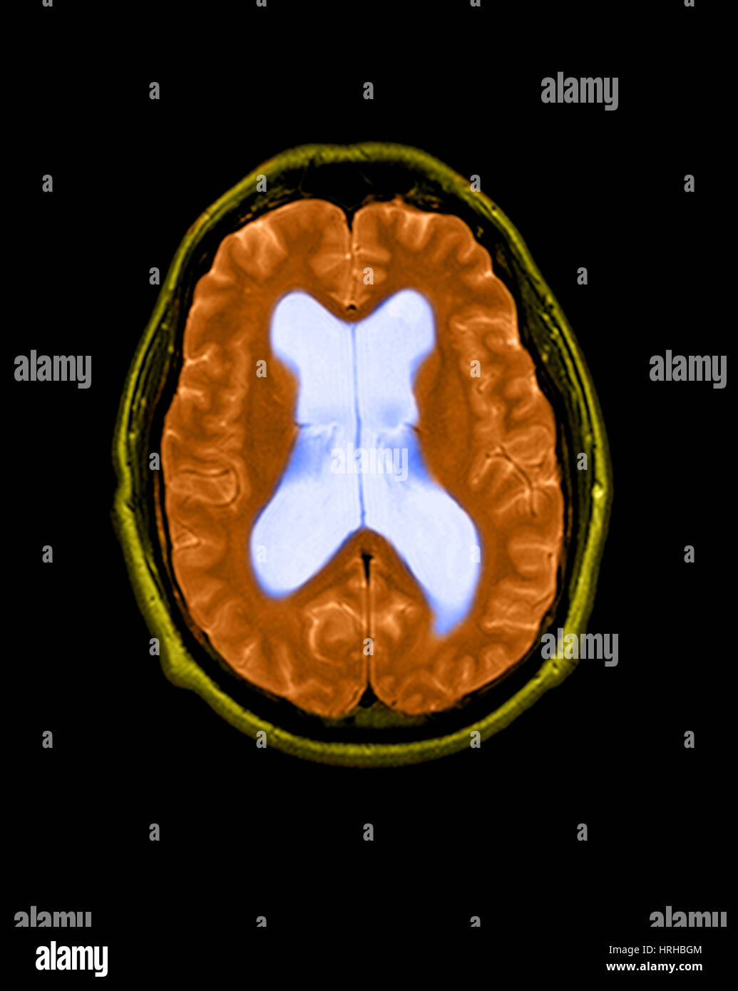 Mri of hydrocephalus hires stock photography and images Alamy