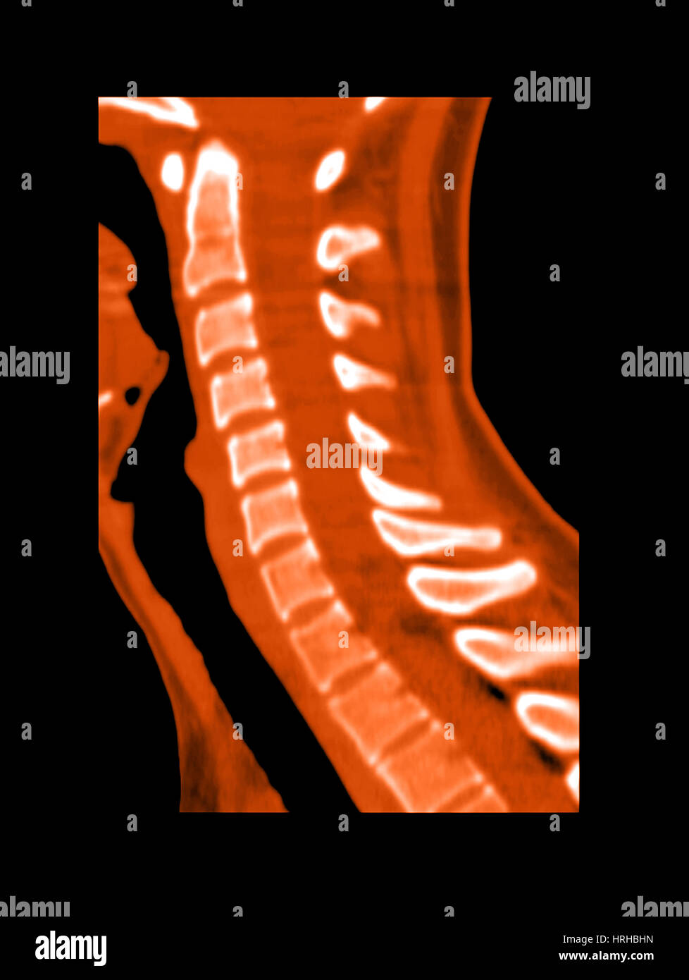 Normal Cervical Spine Stock Photo