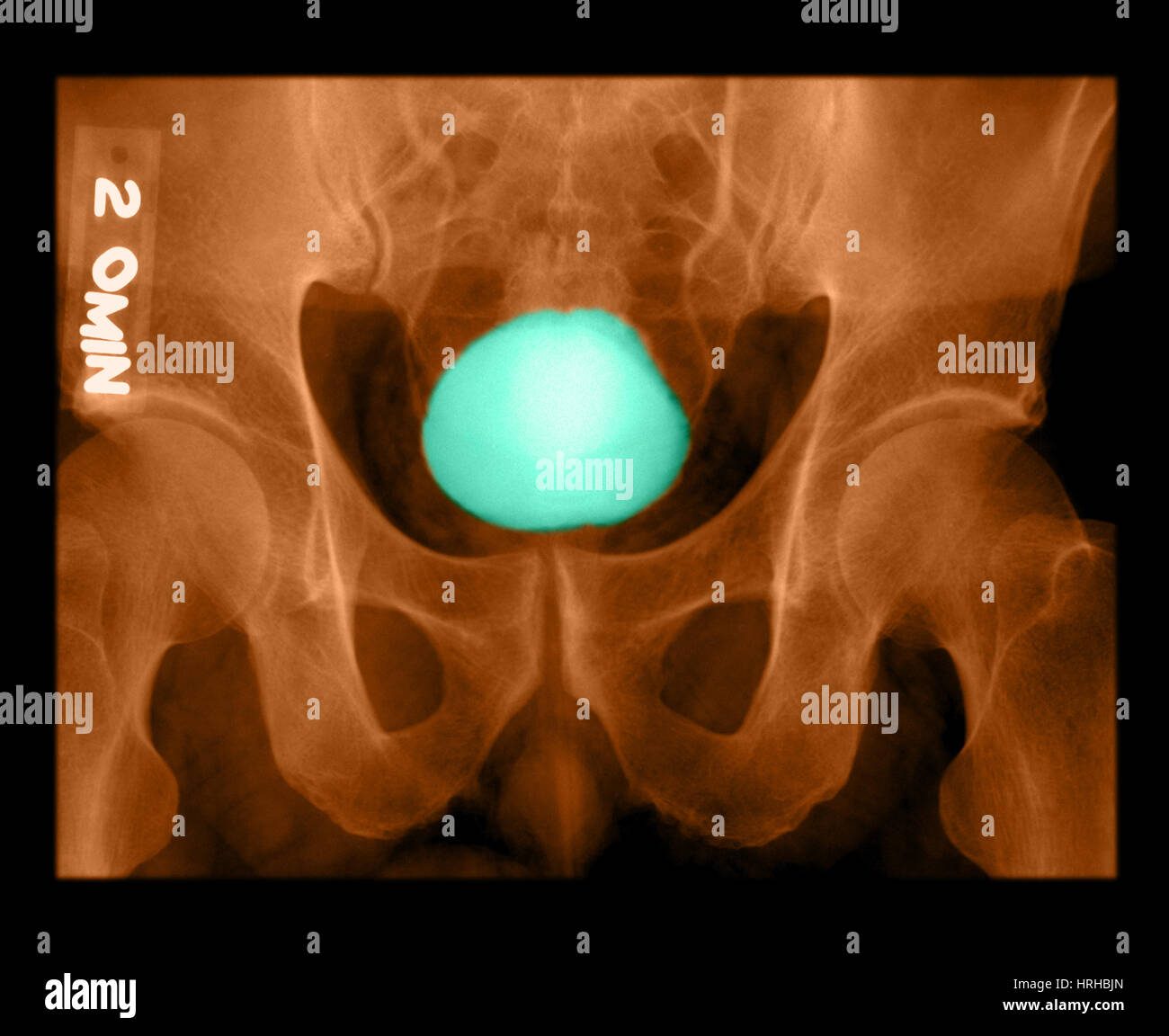 Xray of urinary system hires stock photography and images Alamy