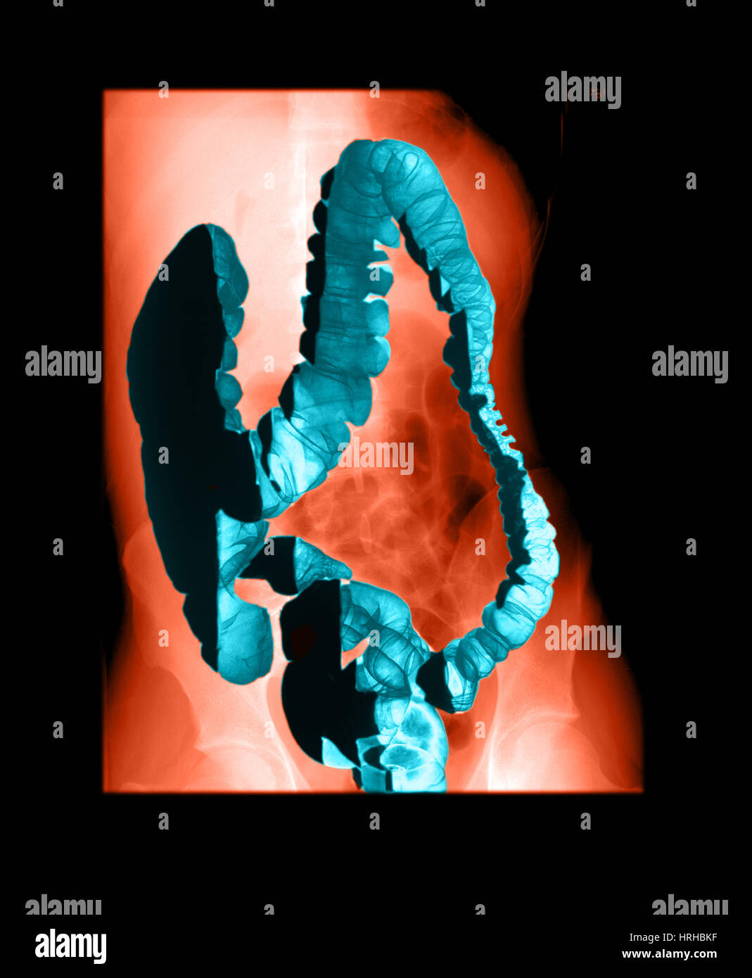 Normal Double Contrast Barium Enema Stock Photo Alamy