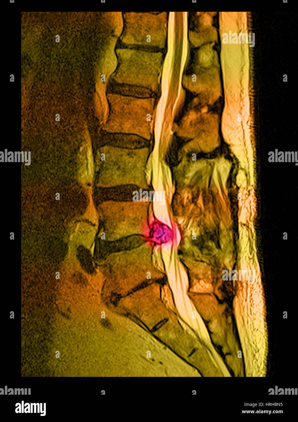 Herniated lumbar disc mri hires stock photography and images Alamy