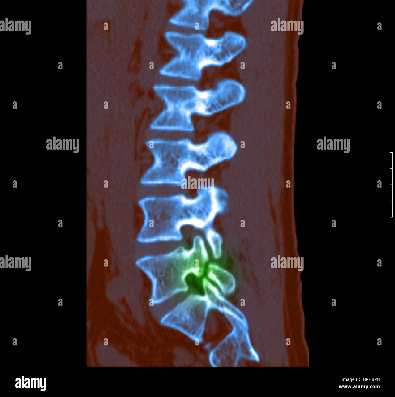 Spondylolysis Stock Photo