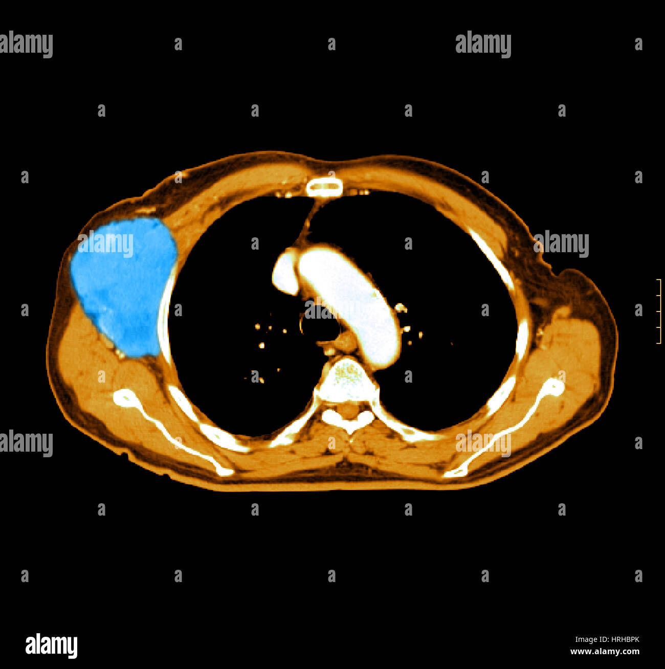 NonHodgkins Lymphoma Stock Photo Alamy NonHodgkins Lymphoma Stock Photo Alamy