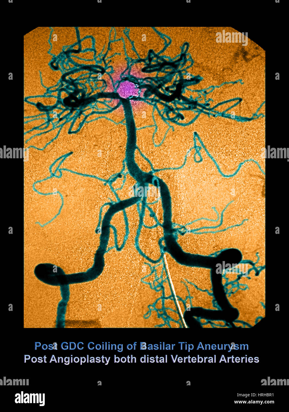 Cerebral angiogram Stock Photo