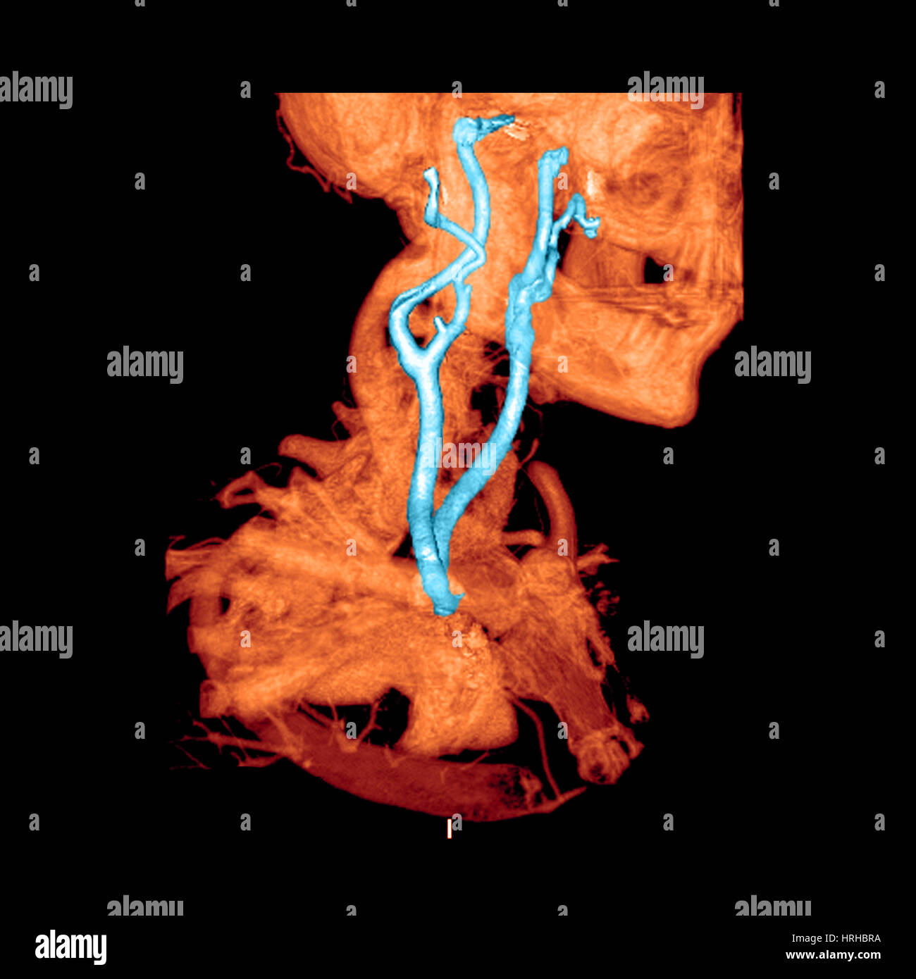 3D CTA of Carotid Arteries Stock Photo Alamy