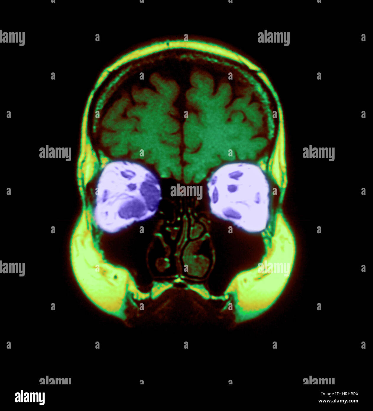 Ocular pathology hires stock photography and images Alamy