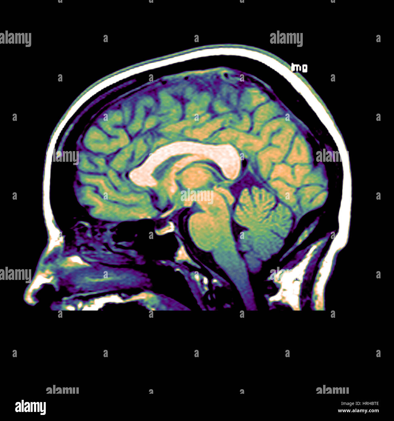 MRI of Brain Stock Photo - Alamy