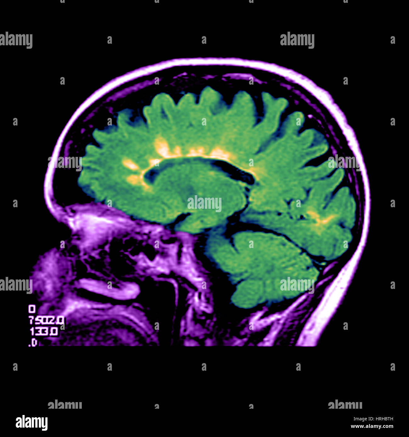 MRI of Multiple Sclerosis Stock Photo - Alamy