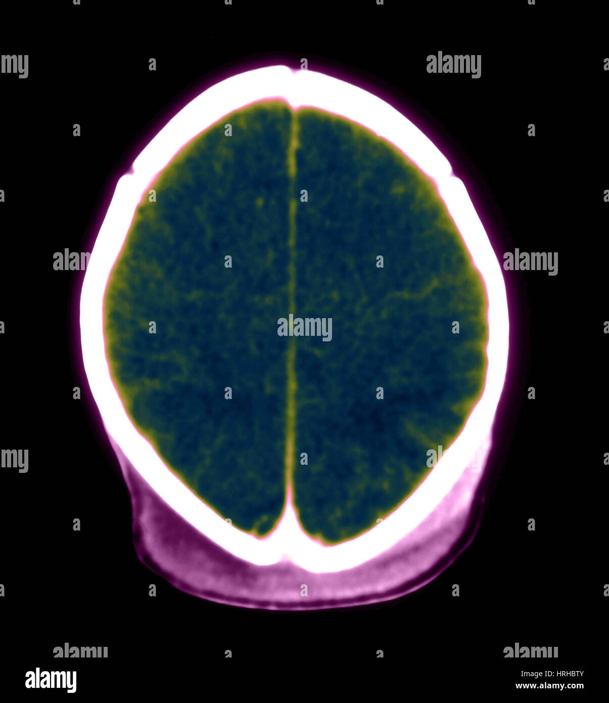 Lack of oxygen to brain hires stock photography and images Alamy