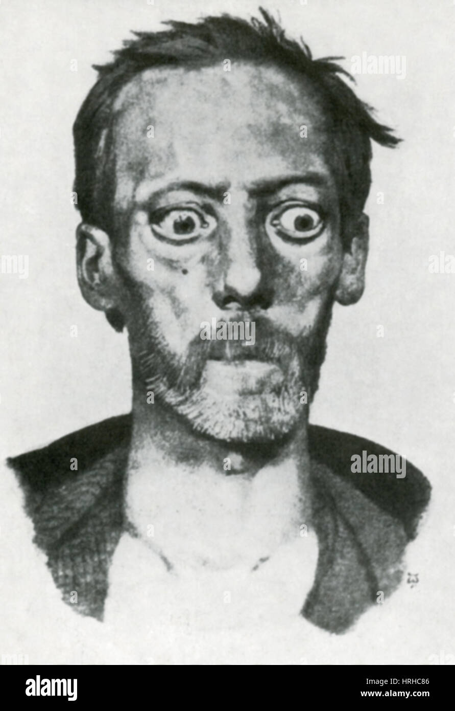 Basedow's graves' disease hires stock photography and images Alamy