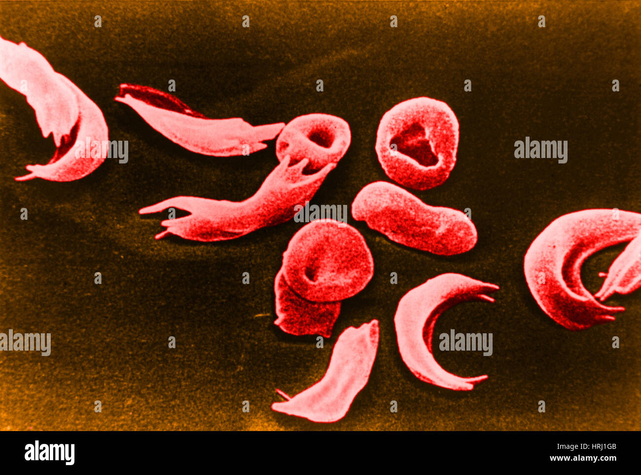 Sickle-cell anemia, SEM Stock Photo
