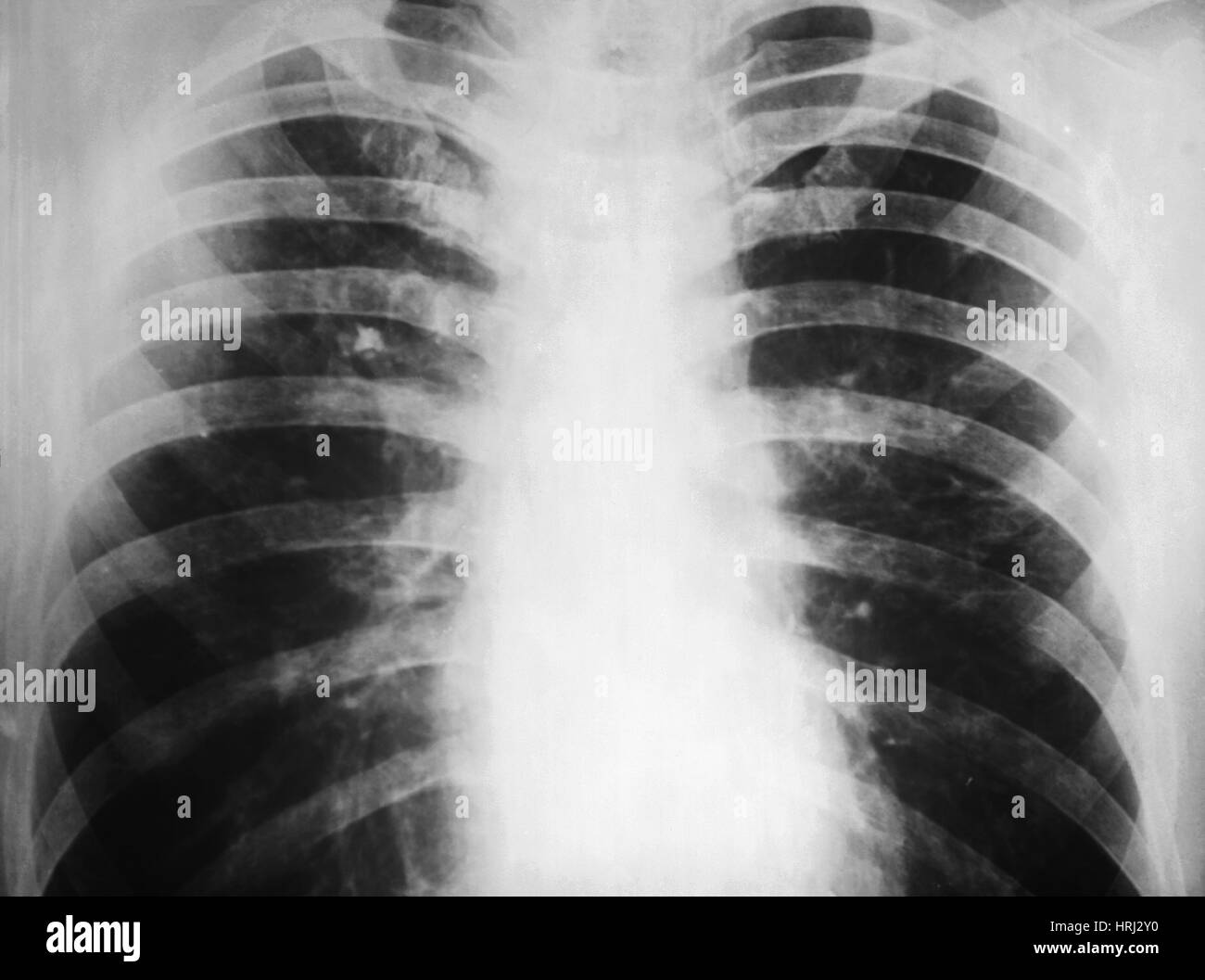 Candidiasis, X-ray Stock Photo