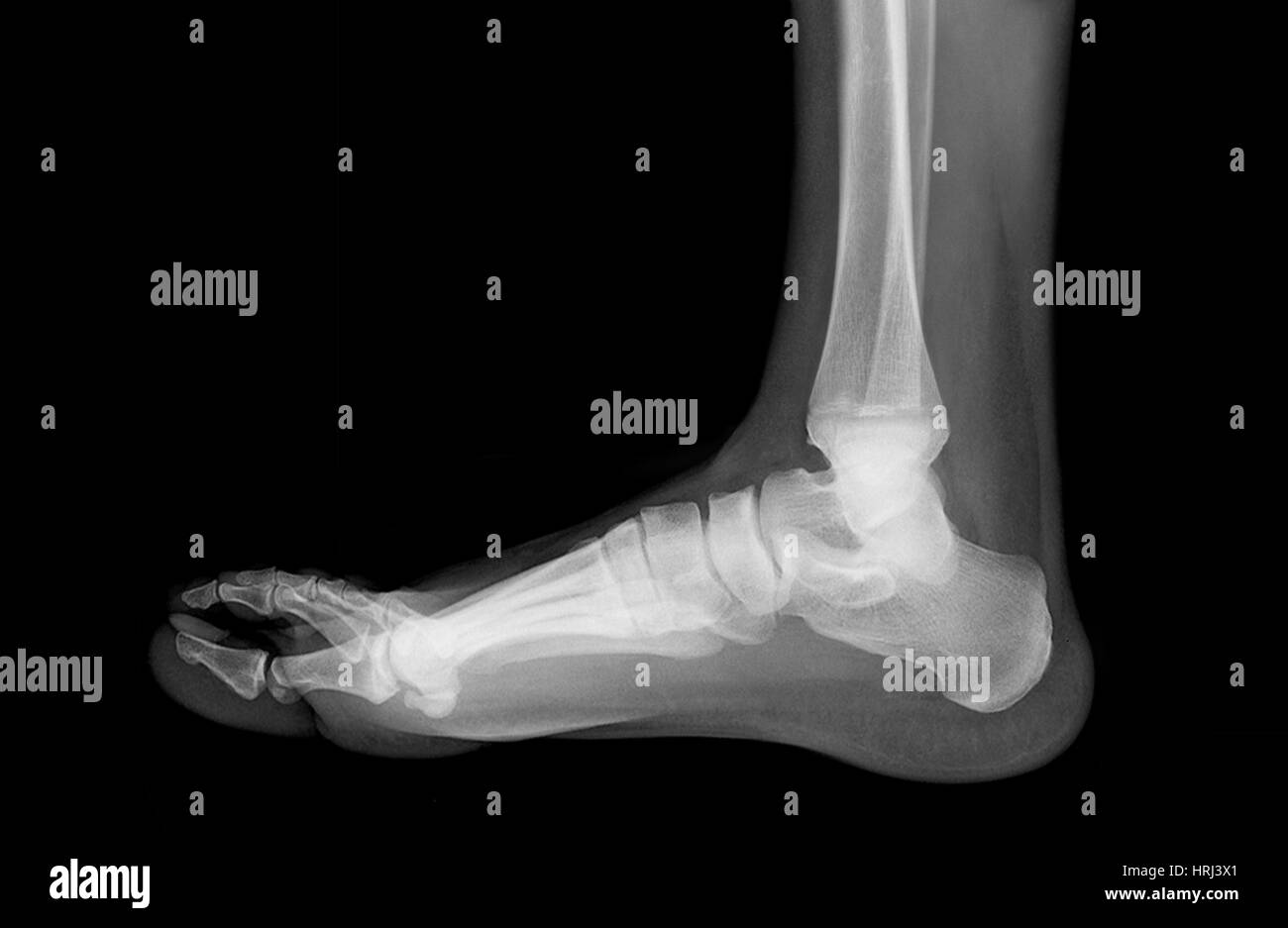 Flat Foot Stock Photo