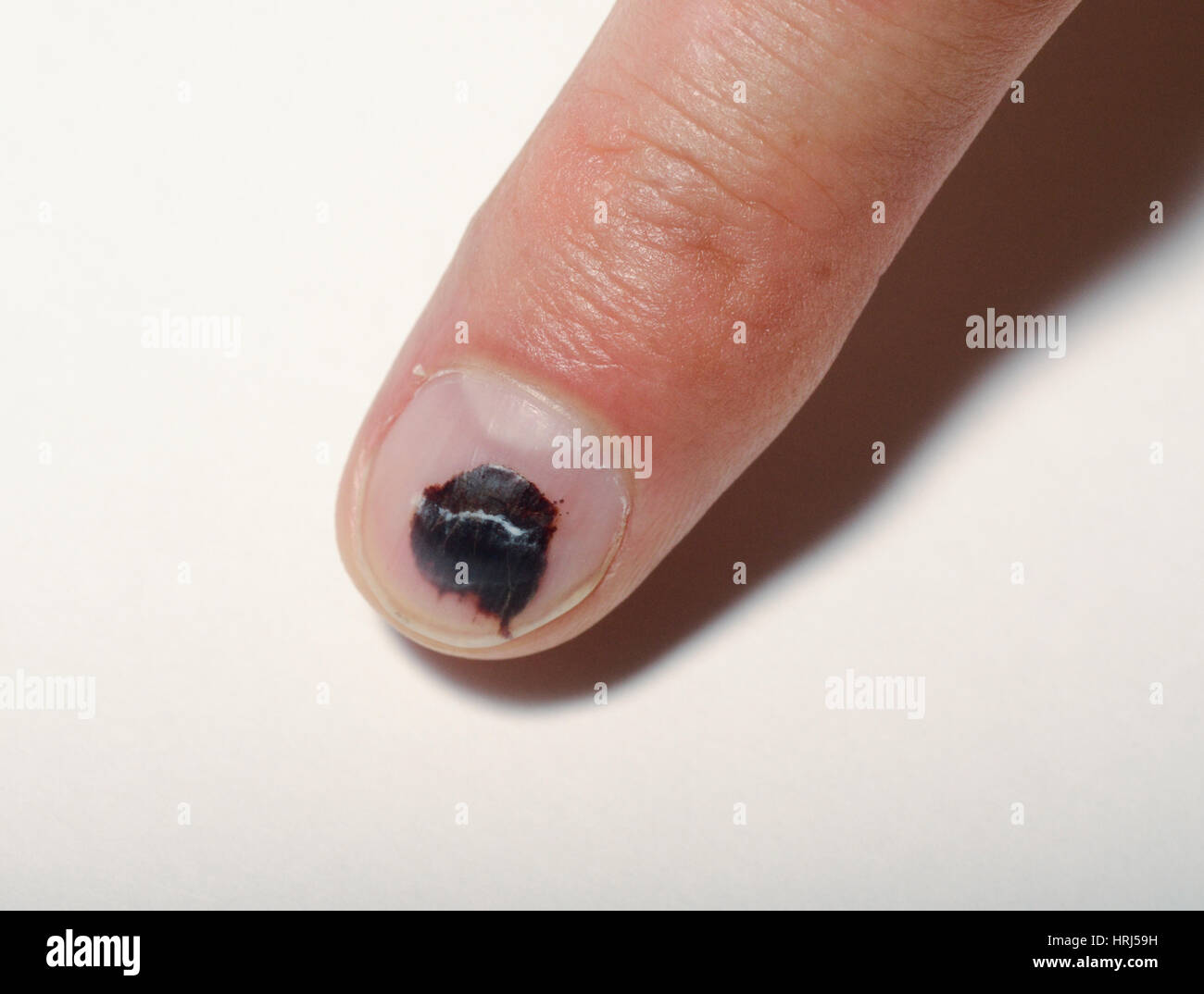 Blackened Nail Of Hand On Black Background Stock Photo - Download Image Now  - Adult, Adults Only, Black Color - iStock