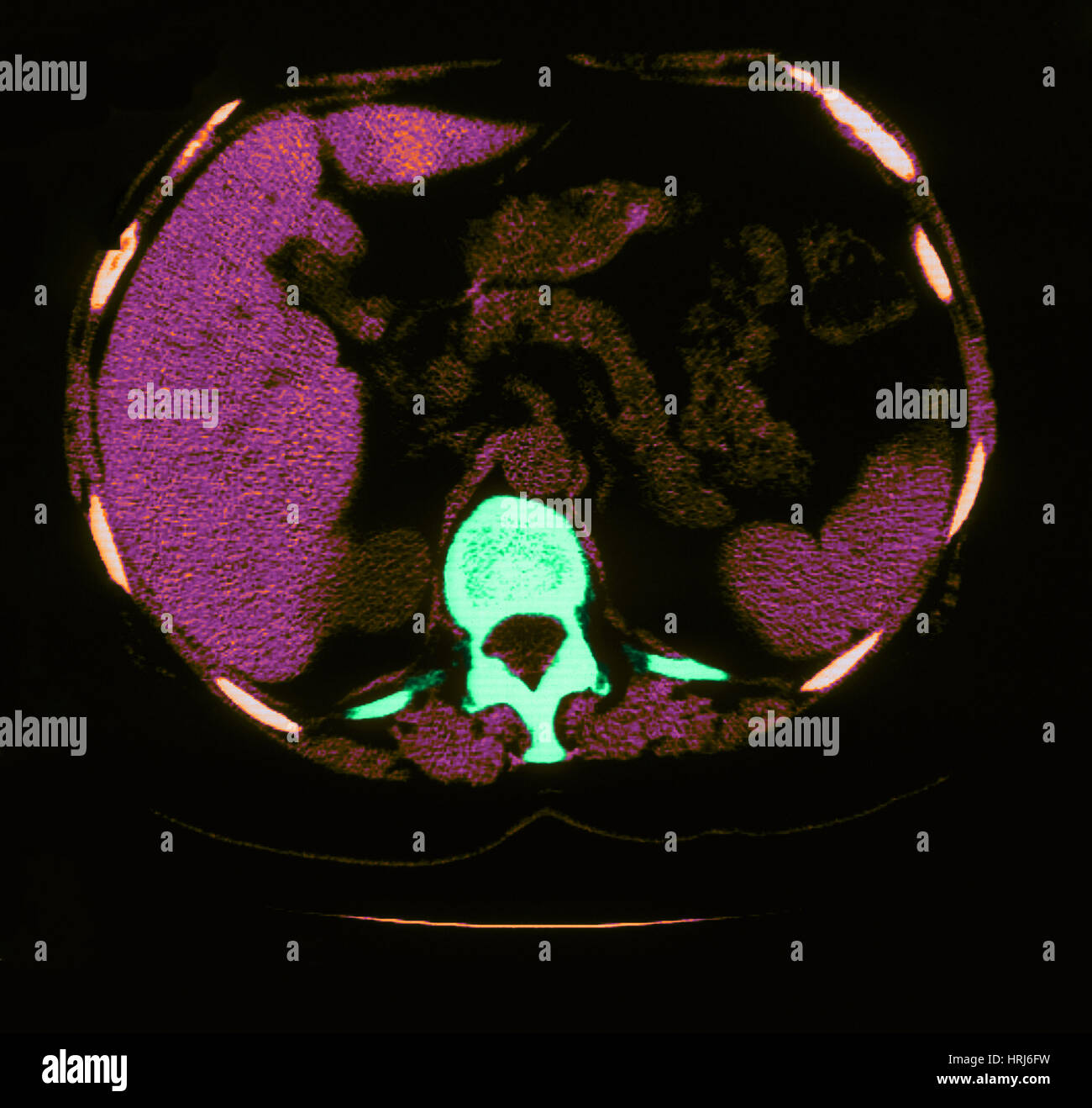 Scoliosis, Granuloma & Calcification in Lung Stock Photo - Alamy