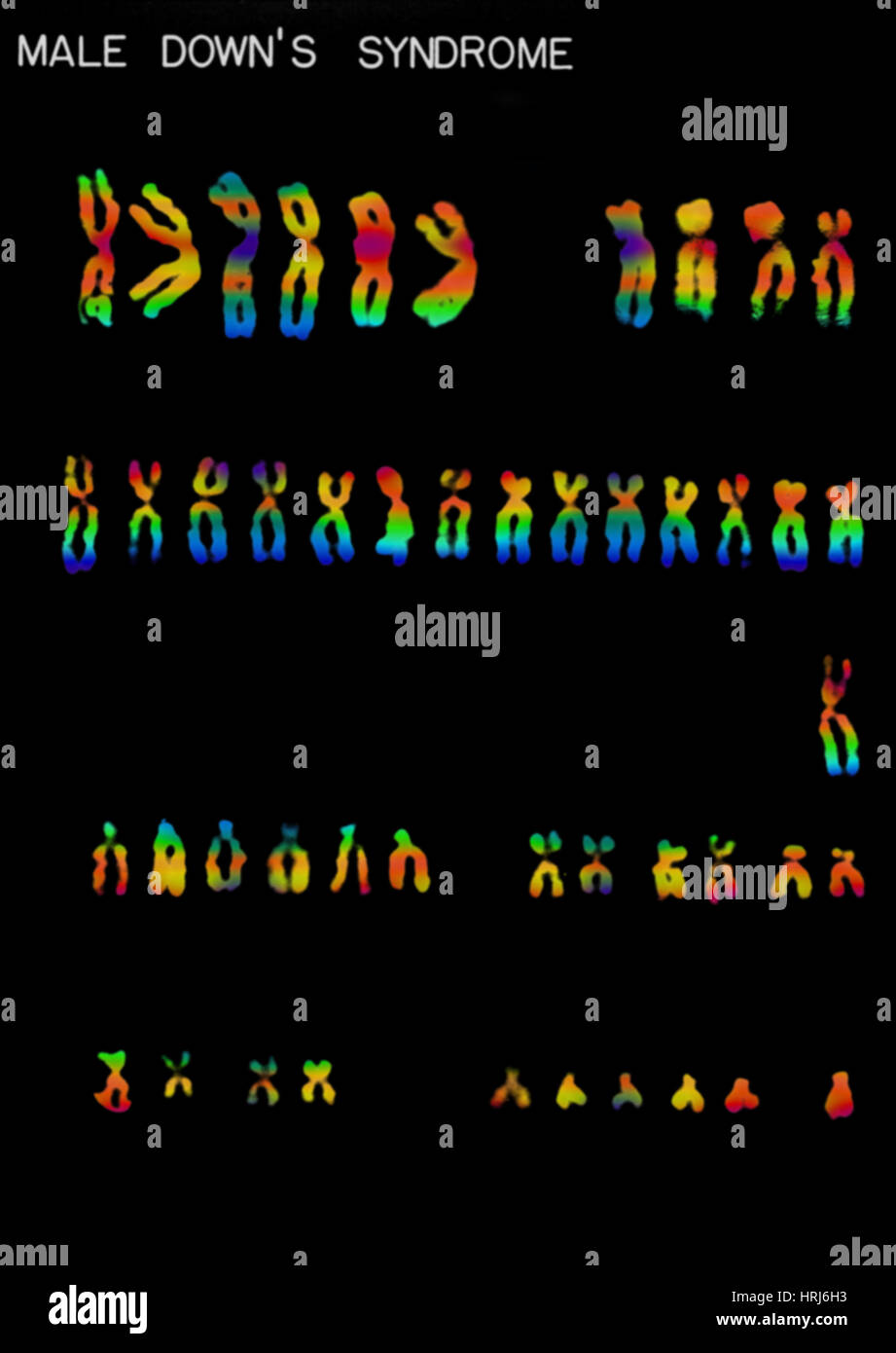 Down's Syndrome karyotype Stock Photo Alamy