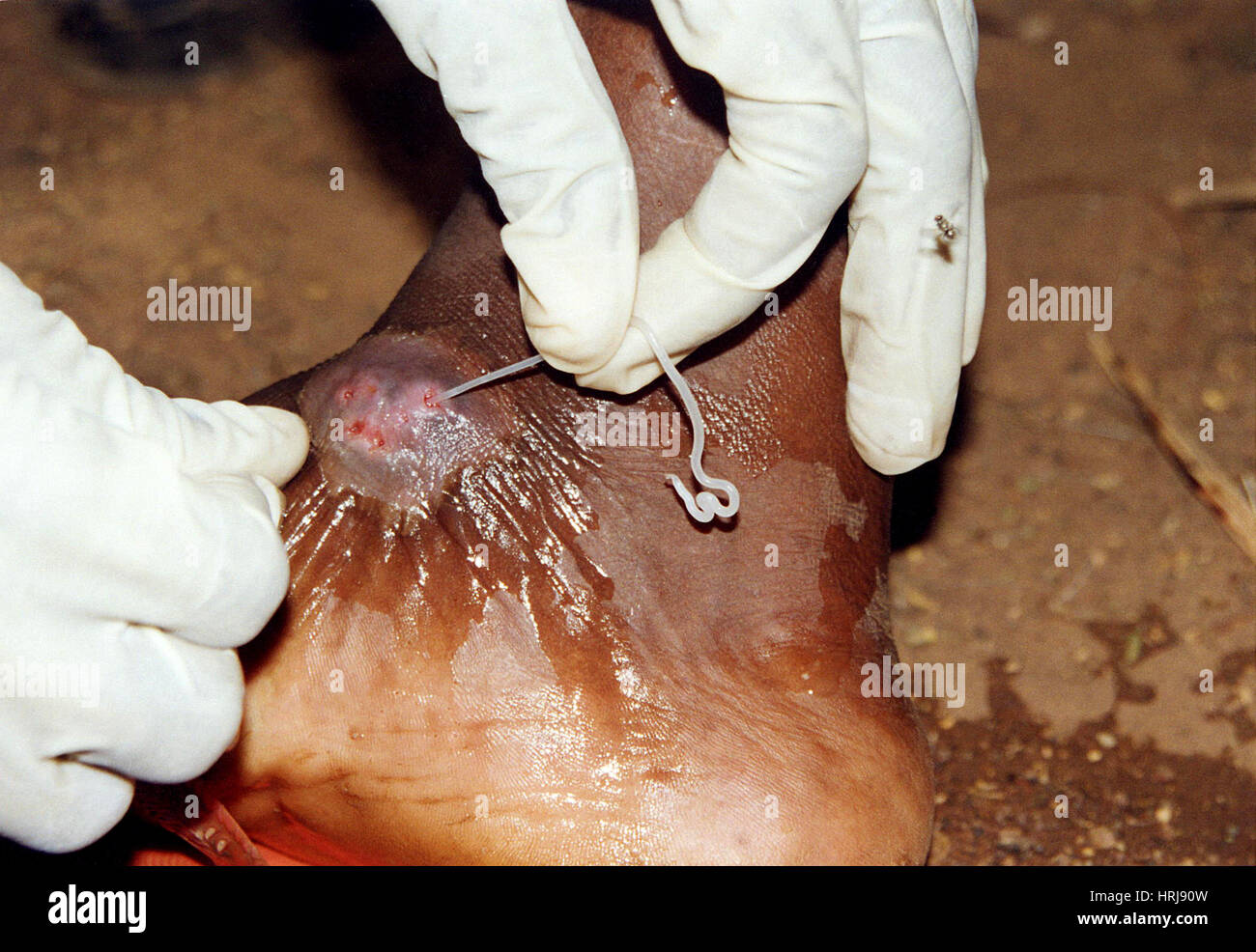 Dracunculus medinensis, Guinea Worm Extraction Stock Photo