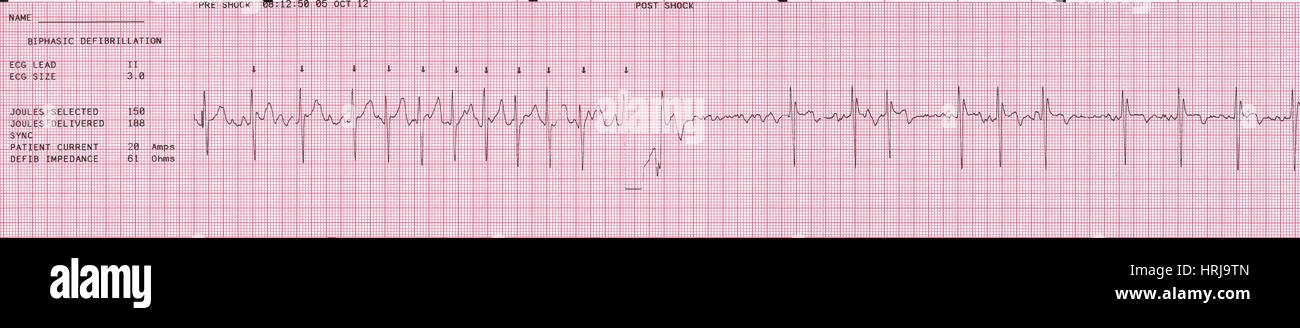 Cardioversion, 1 of 2 Stock Photo