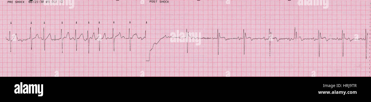 Cardioversion, 2 of 2 Stock Photo