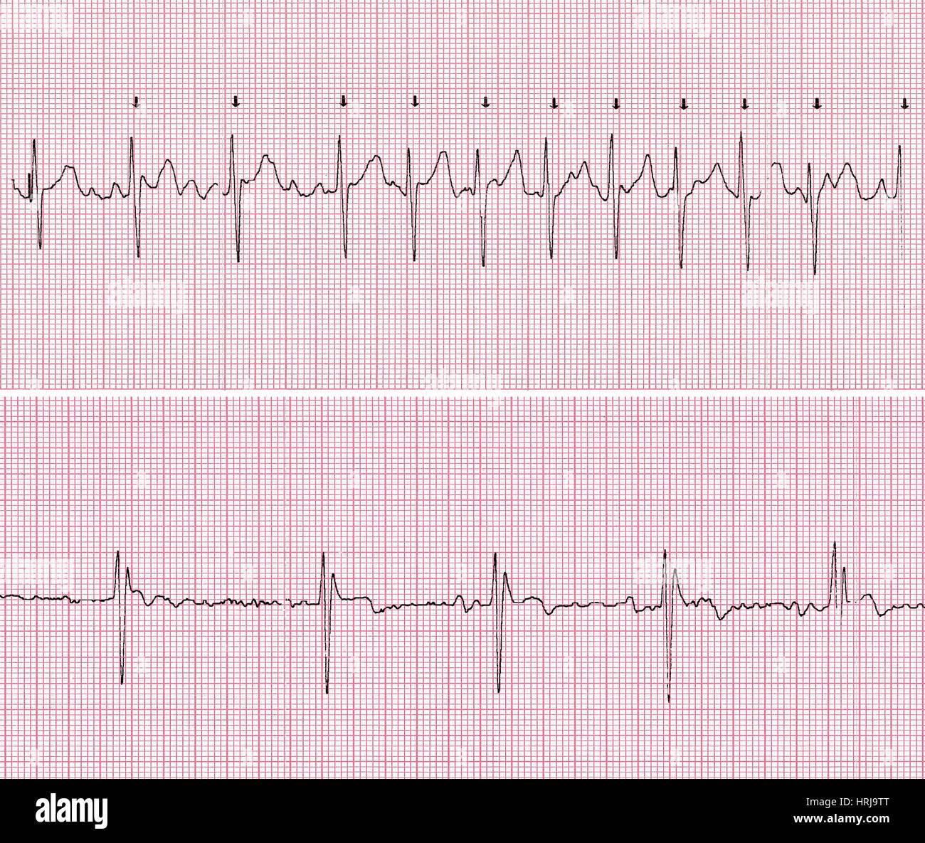 Viagra rapid heart beat