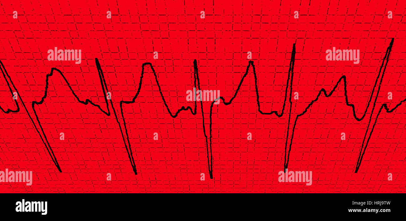 Atrial Fibrillation Stock Photo