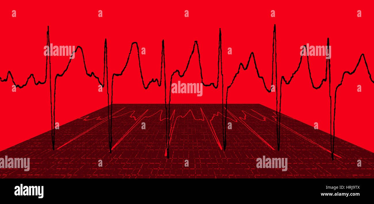Atrial Fibrillation Stock Photo