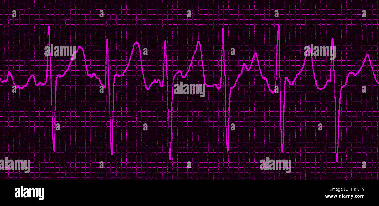 Atrial Fibrillation Stock Photo