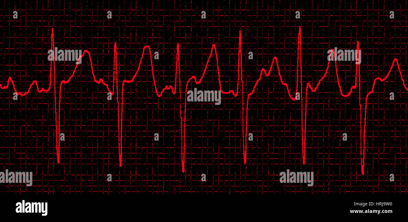 Atrial Fibrillation Stock Photo