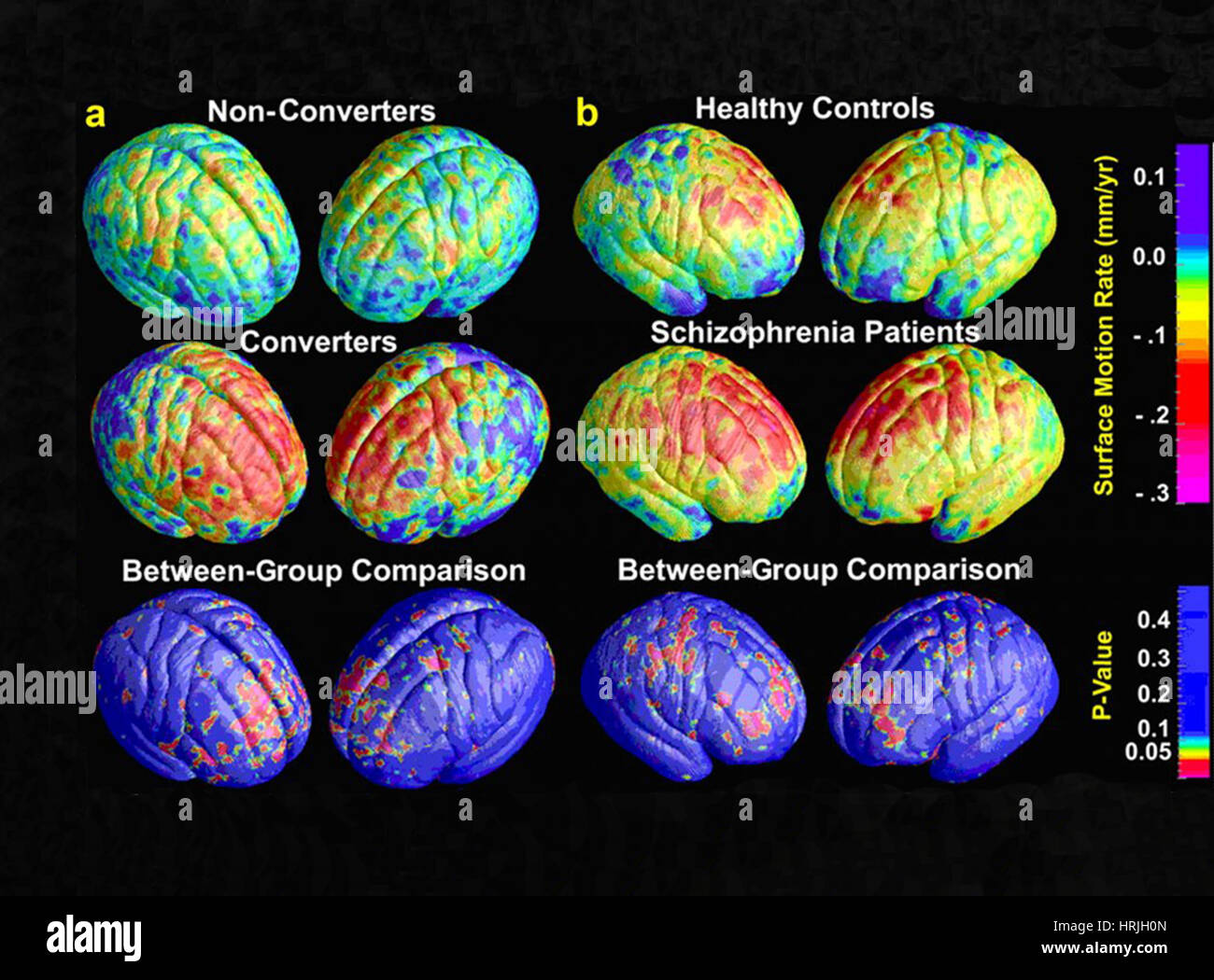 Schizophrenia, 3D MRI Scans Stock Photo - Alamy
