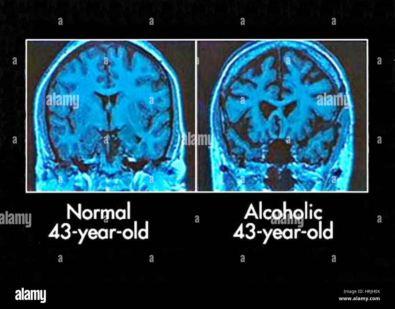Normal And Alcoholic Brains MRI Scans Stock Photo 135018154 Alamy